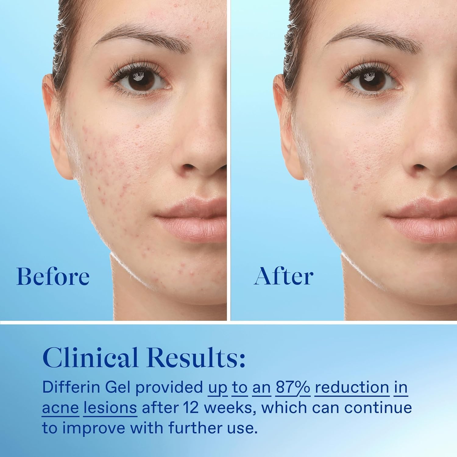 Differin Acne Treatment Gel, 60 Day Supply, Retinoid Treatment for Face with 0.1% Adapalene, Gentle